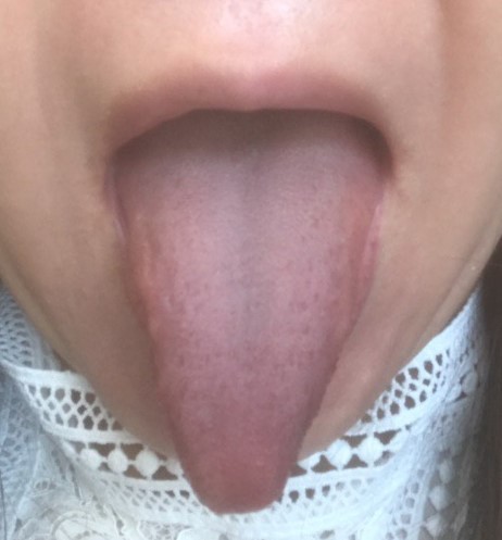 感冒舌苔