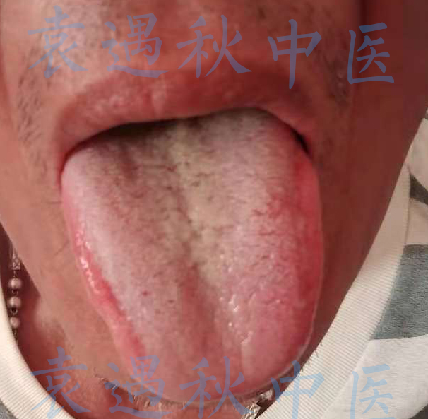 腹胀舌苔