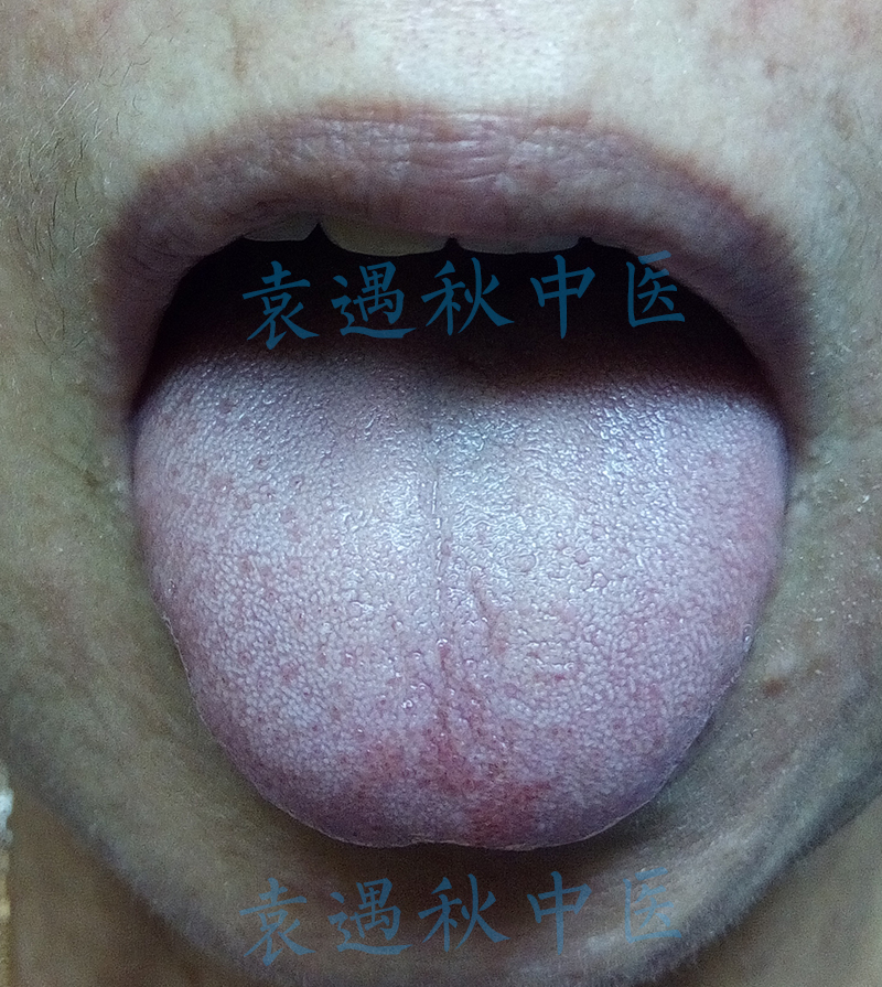 老年风疹瘙痒舌苔