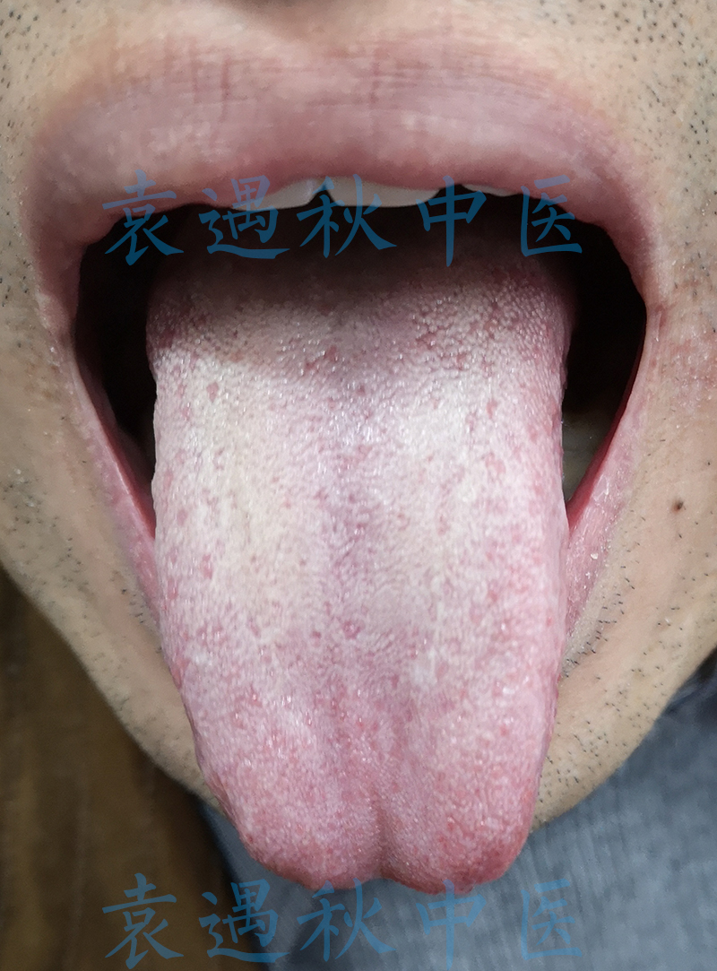 咽痛舌苔