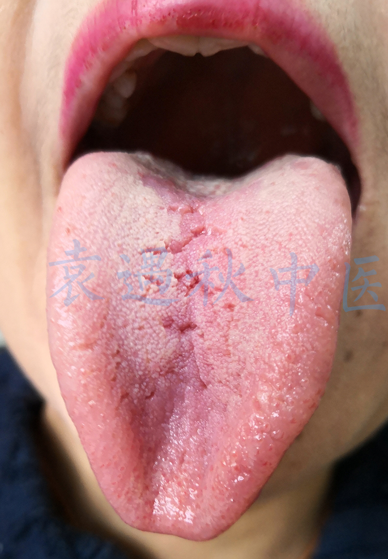 胸痹舌苔
