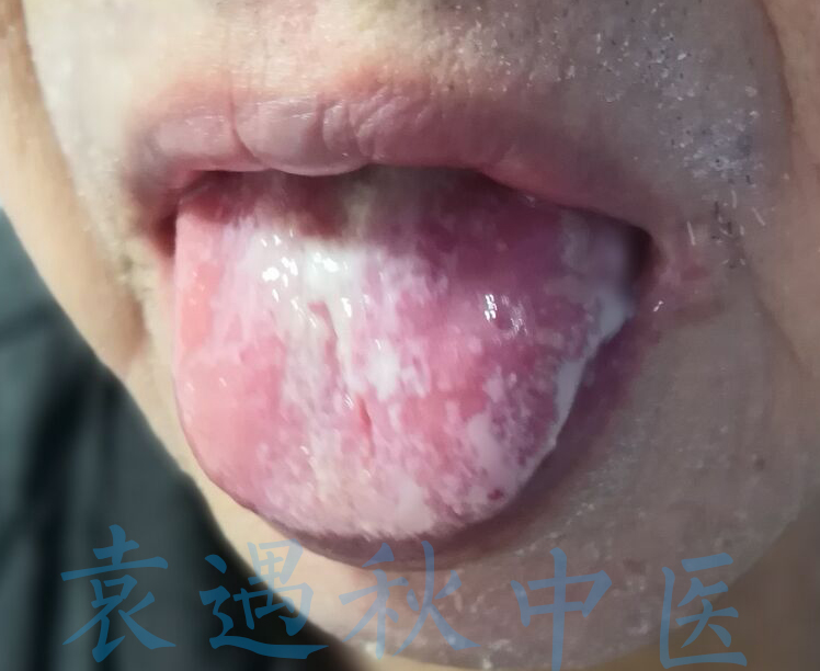口腔溃疡舌苔