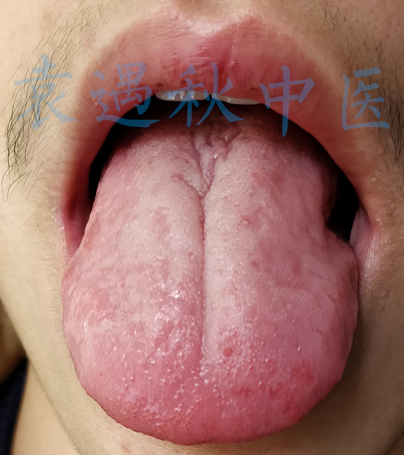 咳嗽舌苔