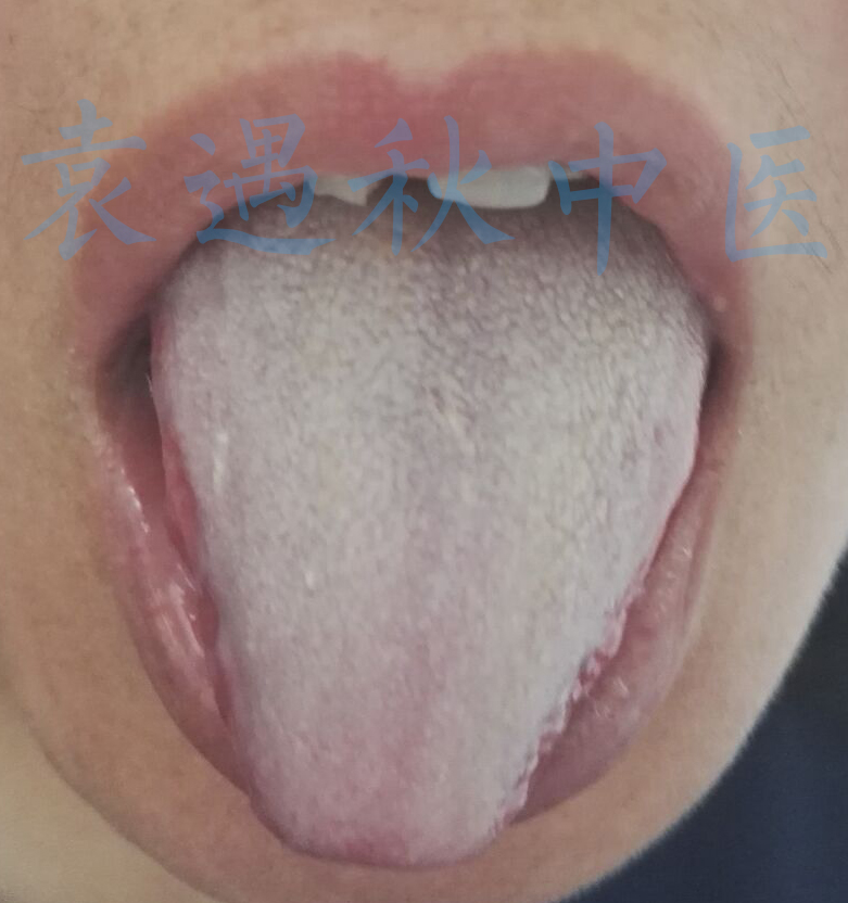 白腻舌苔