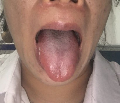舌苔