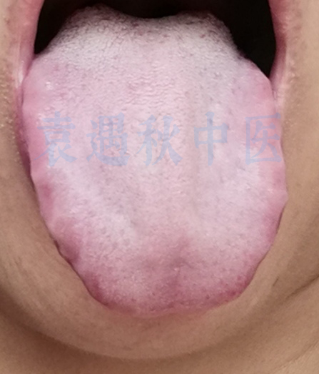齿痕舌