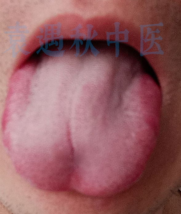 舌苔照片