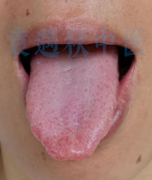 舌苔照片